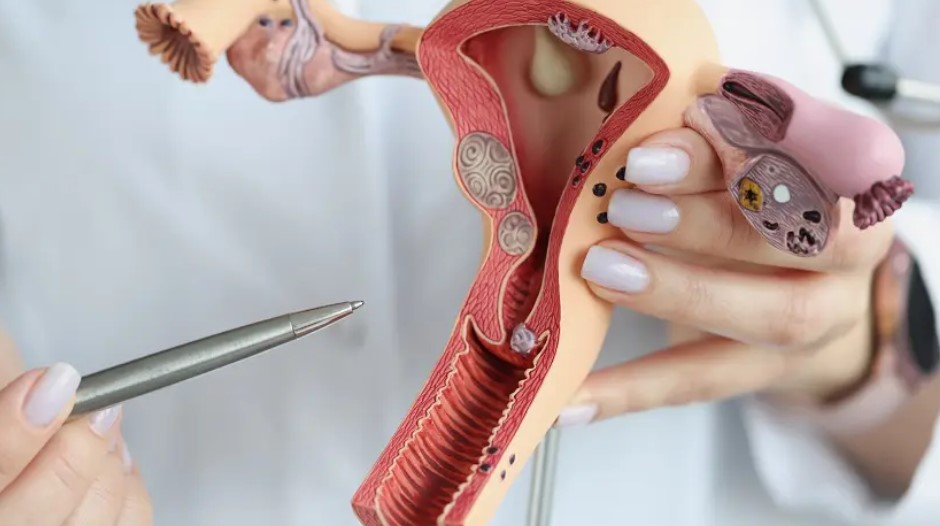 mioma-uterino-dr-jose-roberto-lambert-reproducao-assistida-santo-andre-sp