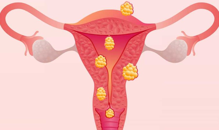miometase-miomas-dr-jose-roberto-lambert-reproducao-assistida-fiv-fertilizacao-in-vitro-santo-andre-sp